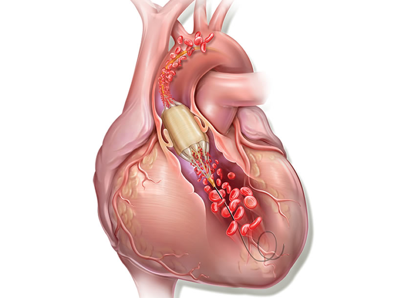 Novel Biomarkers for Aortic Stenosis Identified